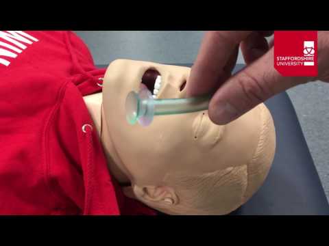 Nasopharyngeal Airway Insertion