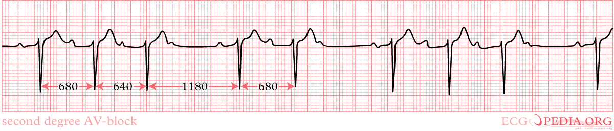 2ndDegree Type1