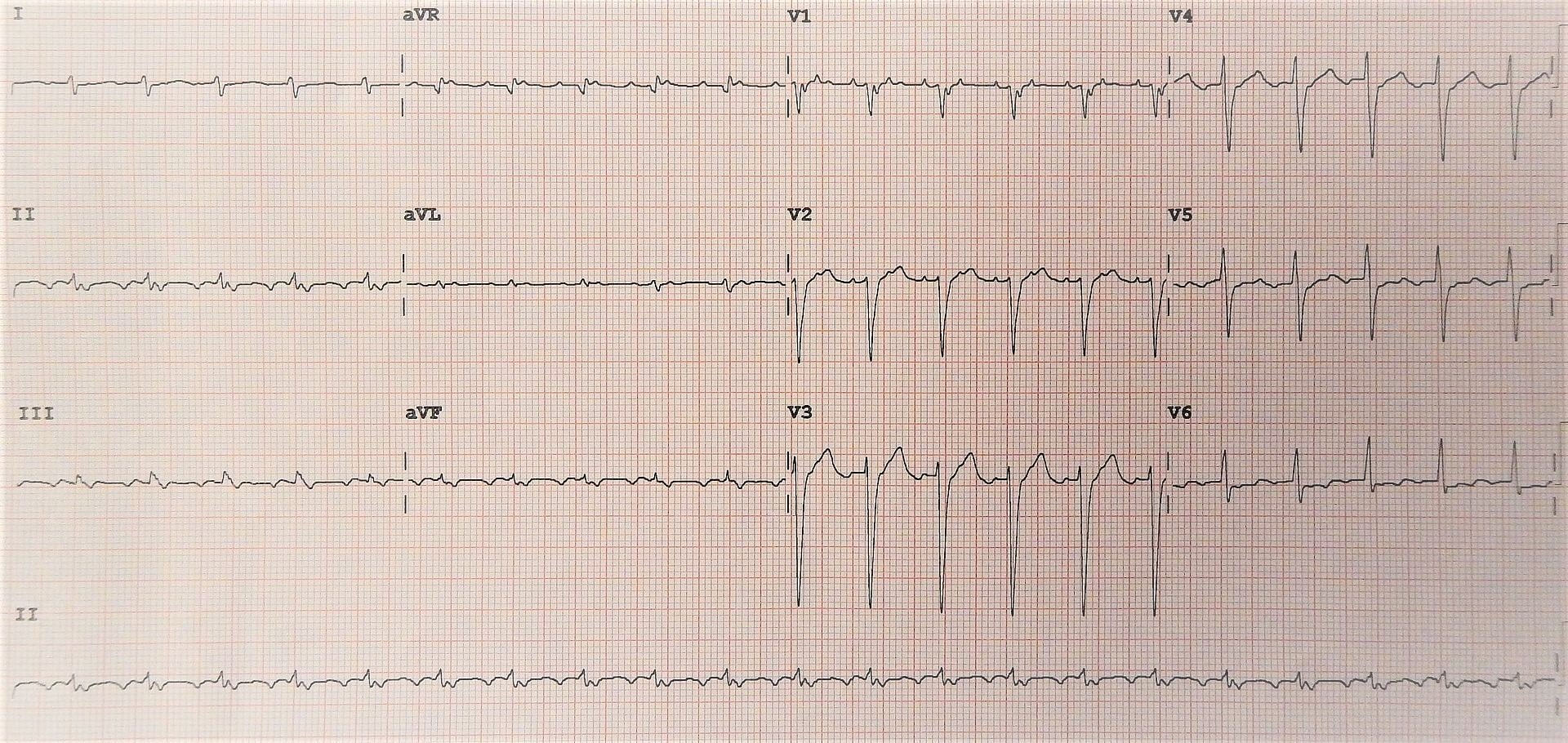 Atrial flutter2 1