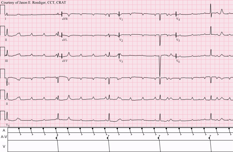 Complete heart block