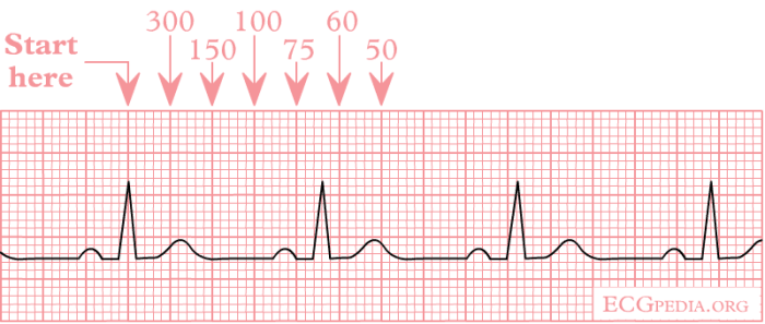 Normal ECG strip