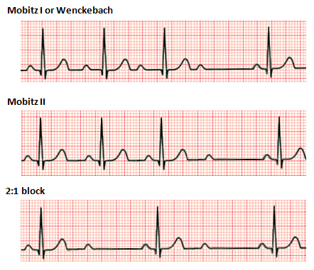 Second degree heart block