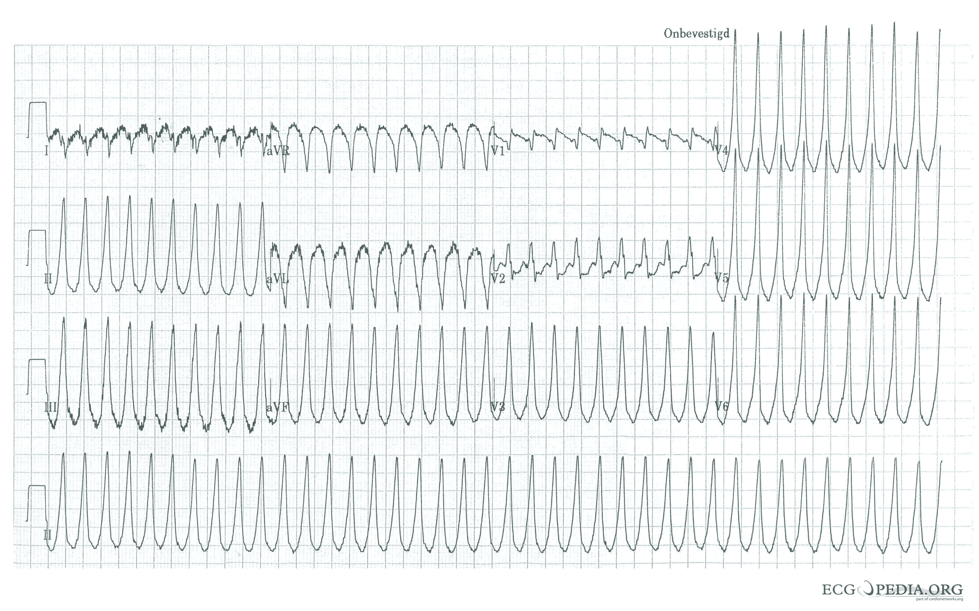 monomorphic VT